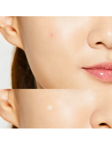 Acne Pimple Master Patch - 24 Parches...