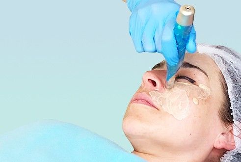 MICRONEEDLING
